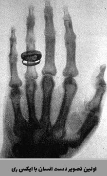 اولین تصویر ایکس ری از دست انسان